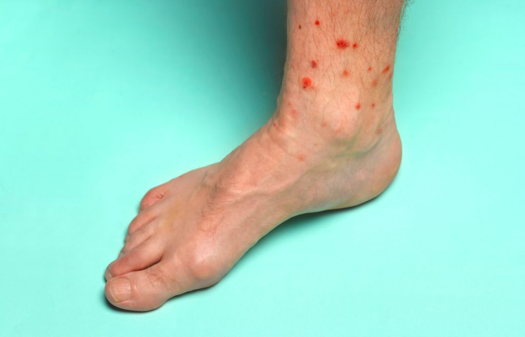 Foot with summer insect bites