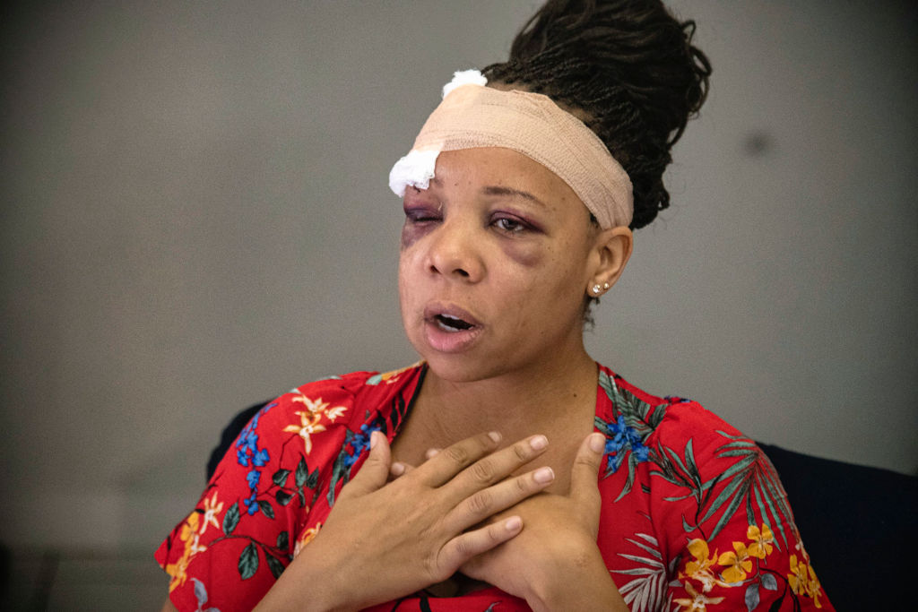 'They ignited the situation': Fort Lauderdale police fractured eye socket of peaceful protester
